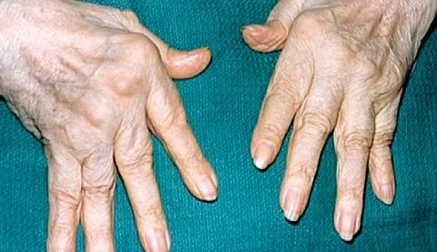Durere în articulațiile degetelor