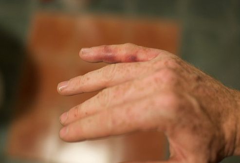 Cum să tratați artrită reumatoidă la domiciliu
