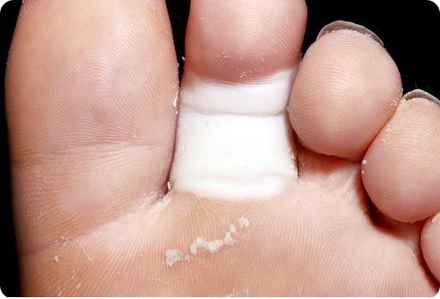 Cauzele fracturii degetelor de la picioare
