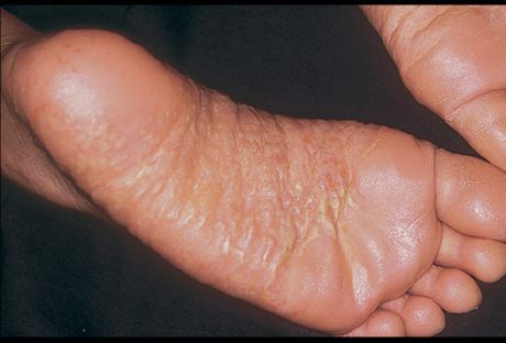 Dermatita de picioare și cauzele acesteia
