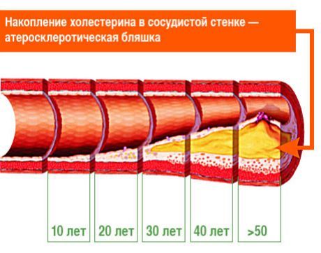 Se clarifică care plăci aterosclerotice sunt responsabile pentru accident vascular cerebral