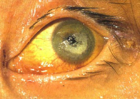 Keratita bilaterală cauzată de Candida la un copil cu imunodeficiență severă