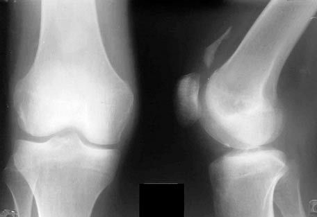 Roentgen al articulației genunchiului