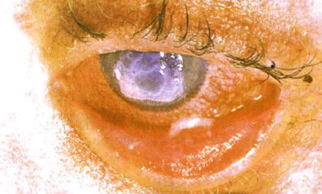 Sindromul Stevens-Johnson.  Conjunctivită desquamativă pe două fețe cu zone de necroză.  Keratita severă, care a provocat apariția cicatricilor pe cornee.  Situația a fost complicată de adăugarea sindromului ochilor "uscați"