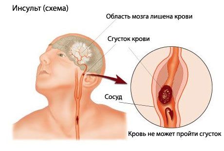 Un test ușor prezice un accident vascular cerebral fatal