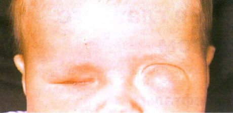 Micoftalmul cu formarea chisturilor concomitente (ochiul stâng).  Anophthalmus (ochiul drept).