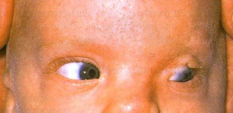 Sindromul Fraser.  Cryptophthalmos incompletă a ochiului stâng.