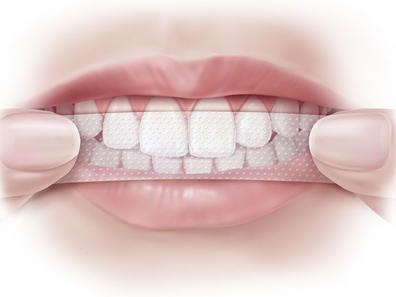 Cum se utilizează benzi de albire pentru dinți?