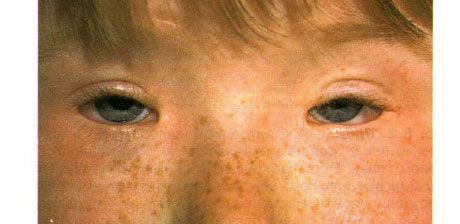 Sindromul de blefarofimoză.  Ptoză operată pe două fețe, telecanthus și blefarofimoză