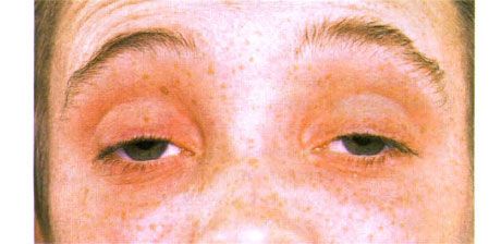 Oftalmoplegia externă.  Ptoza pe două fețe.  Pacientul își deschide ochii prin ridicarea sprancenelor