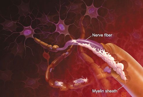 Cum funcționează scleroza multiplă