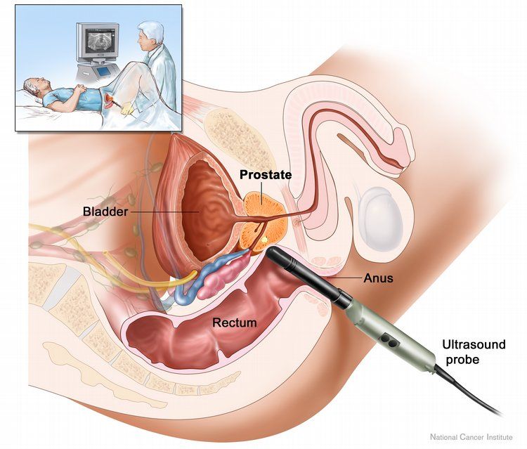 A fost creat un medicament eficace împotriva cancerului de prostată pe bază de ceai și aur