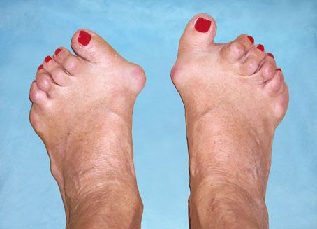 Artrita piciorului piciorului. Poliartrita reumatoida