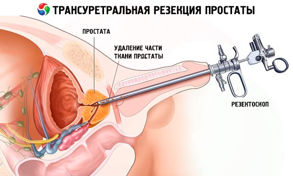 prevenirea glandei prostatei la bărbați)