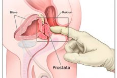 durere de prostatită în anus