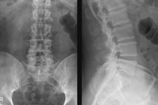 osteoartrita coloanei vertebrale lombosacrale