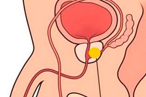 antiinflamatoare prostatită
