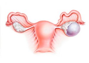 ovarian timpul sarcinii: simptome, diagnostic, tratament
