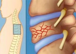durere surdă la nivelul coloanei vertebrale toracice