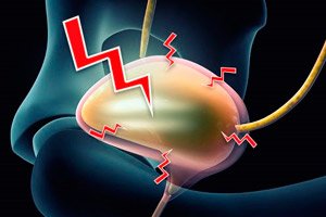 Bowling Annihilate course Sindromul vezicii urinare iritabile: simptome, tratament