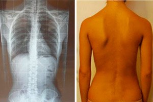 Prevenirea osteocondrozei coloanei vertebrale și tratamentul acesteia