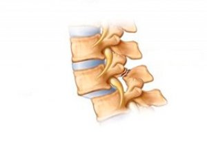 tratamentul vertebrelor compresive ale coloanei vertebrale