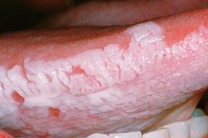 Penis leucoplacie, Negi genitale: aspect și simptome