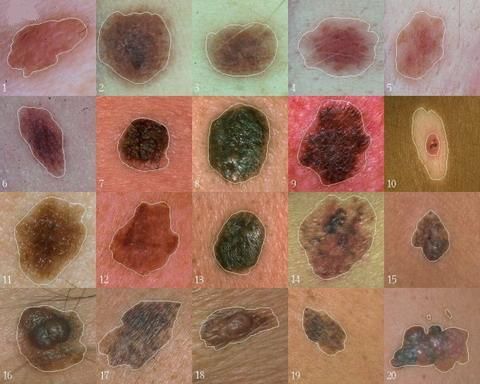 Oamenii de stiinta au descoperit o gena care joaca un rol central in dezvoltarea melanomului