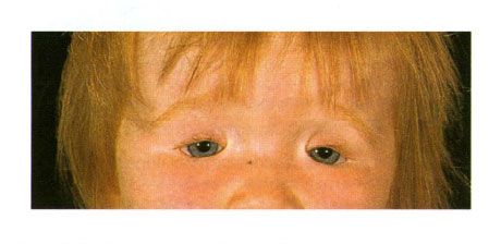 Coloboma pe două fețe a pleoapelor la un copil cu sindromul Golden.  Închiderea fantei pentru ochi din stânga