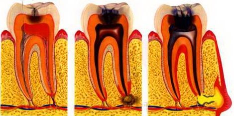 Durerea de dinți după umplere 